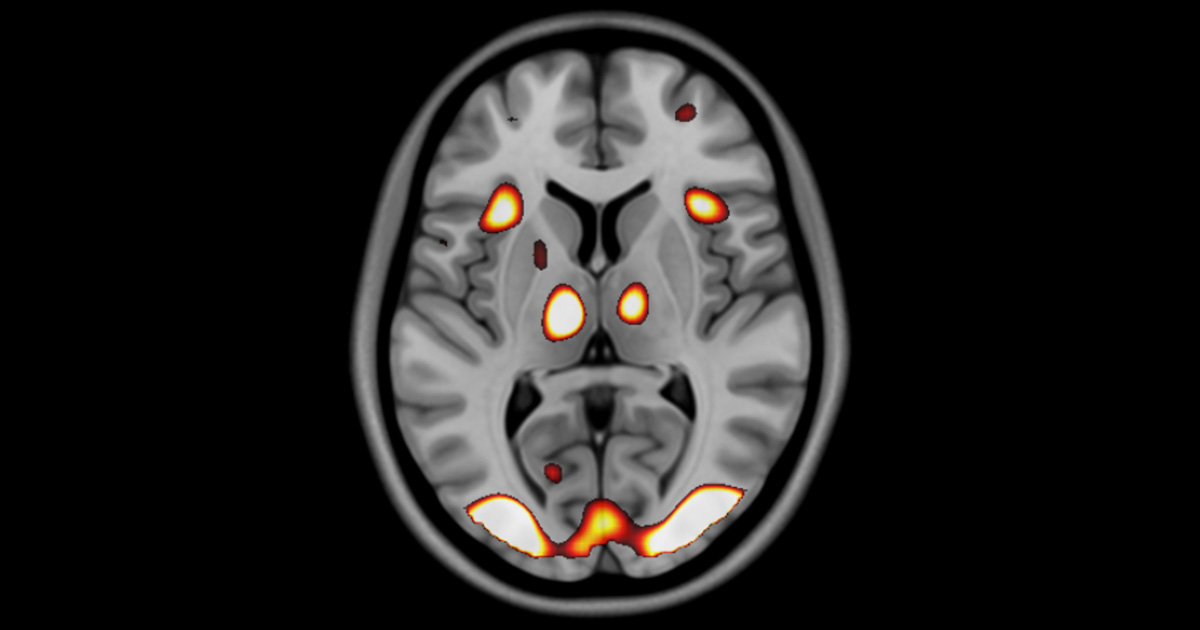 L'esprit au travail : exemple d'une scintigraphie du cerveau